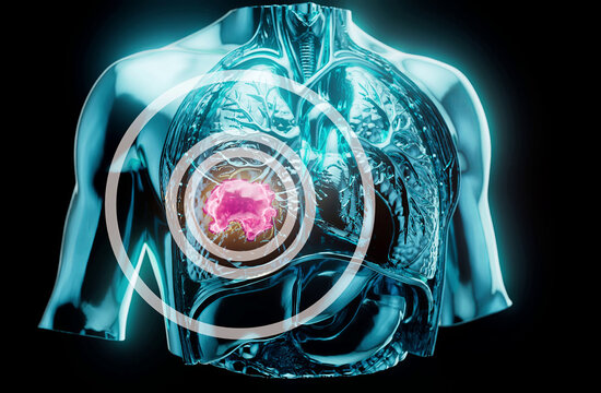Conceptual 3D illustration of lung cancer and tumor growth in the lungs