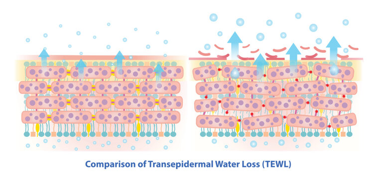 The mechanism of transepidermal water loss on healthy and damaged skin barrier illustration. Comparison of amount of water that pass from inside through the epidermis and evaporates from skin surface.