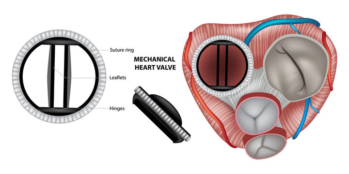 Mechanical prosthetic heart valve implanted in the mitral valve position, with comparison to the normal cardiac valves and enlarged views of the mechanical valve structure. 