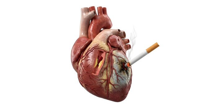 3D Scientific Render of Smoking Damage to Human Heart: Myocardial Infarction, Necrosis, and Blocked Coronary Artery.