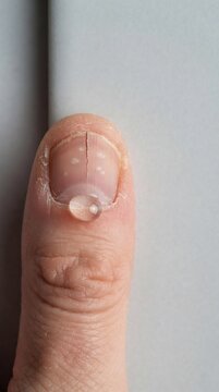 Macro view of cracked thumb with water droplet