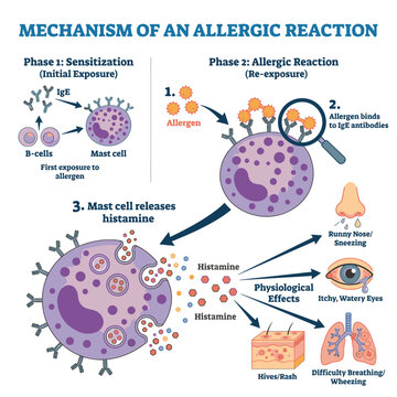 An illustration detailing the mechanism of an allergic reaction, showing sensitization and the subsequent allergic reaction with physiological effects