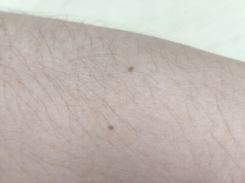 Small Brown Moles on Forearm Skin Close Up