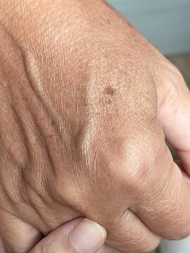 Age Spot and Brown Pigmentation on Mature Hand Close Up
