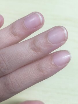 Dry Peeling Cuticles and Hangnail Around Fingernails Close Up