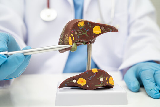 Cirrhosis, Liver cancer, fatty liver, Asian doctor with liver human model.