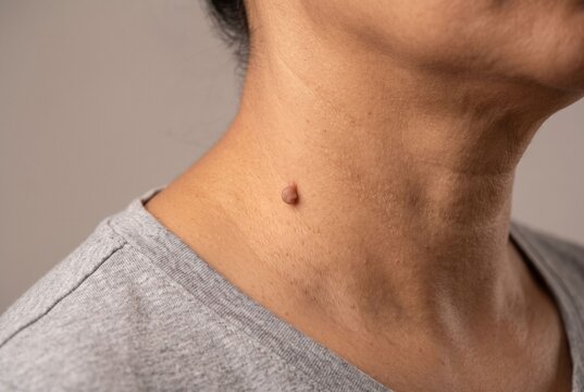 Close up of a single benign skin tag acrochordon on human neck skin