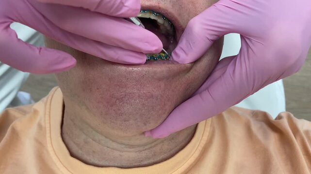 Orthodontist working on a patient&rsquo;s braces removing elastics with pick instrument, equipment, tool