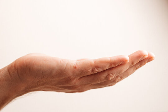 Close up of splinter and redness on hand