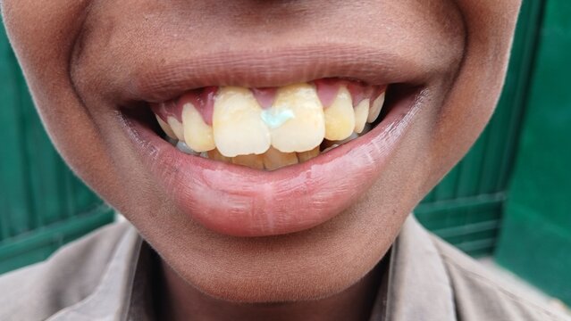 Unhygienic teeth of human, unhealthy gums and tooth, oral hygiene concept.
