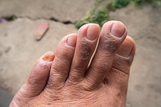 Foot skin condition dry scaling toes dermatology