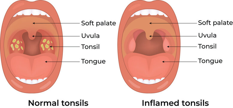 Normal and Inflamed Tonsils Comparison Medical Illustration