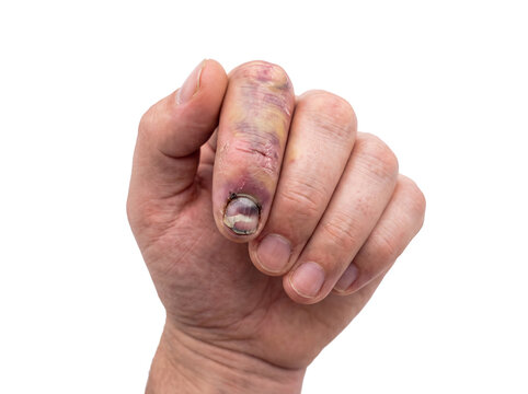 Human hand with a hard damaged finger and nail.