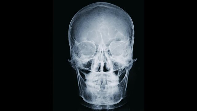Frontal View X-ray Radiograph of a Healthy Human Skull and Facial Bones