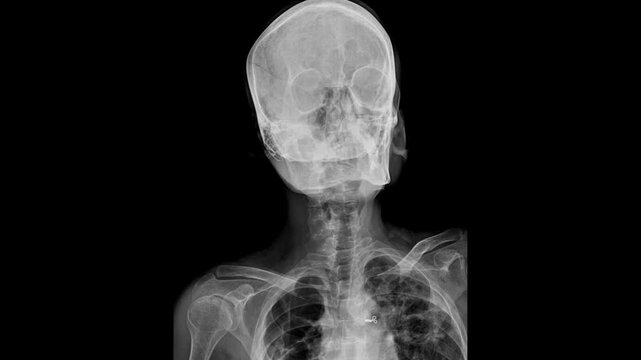 Medical X-ray Radiograph Showing Upper Cervical Spine and Skull Base
