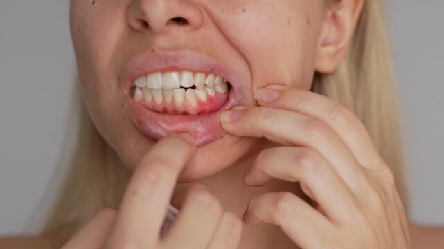 Young woman shows inflamed lower gums and traces of blood, illustrating oral irritation, bleeding, gum disease symptoms and painful sensitivity inside the mouth