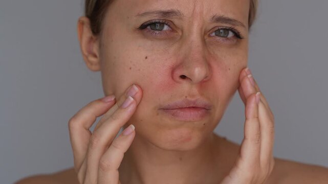 Young woman touches red skin around nose, showing irritation and dryness caused by runny nose, frequent wiping, cold symptoms, allergy or mild dermatitis