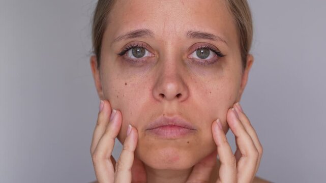 Young woman holding her face with both hands and looking exhausted, demonstrating dark circles under her eyes, tired skin and a sad morning mood