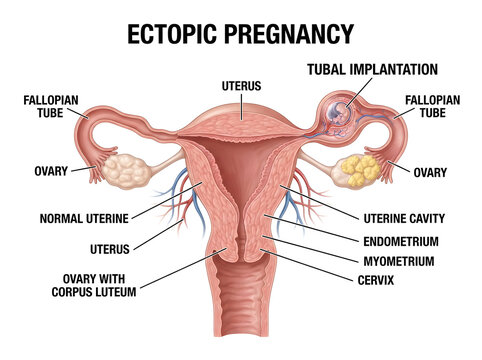 Ectopic pregnancy medical illustration with uterus and fallopian tubes isolated on white background