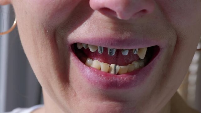 Close-up of woman's dental prosthetics installation. Close-up of a woman's mouth smiling widely, showing the process of dental prosthetics with prepared teeth and metal posts for ceramic crowns