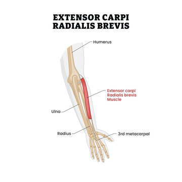 Extensor Carpi Radialis Brevis muscle anatomy labeled diagram, educational musculoskeletal poster design healthcare scheme, forearm muscle anatomy. Labeled Humerus, Ulna, Radius, 3rd Metacarpal