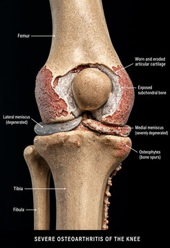 Anatomical illustration showing severe osteoarthritis in knee joint anatomy