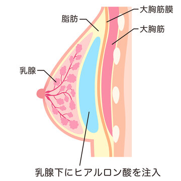 豊胸手術の構造　乳腺下にヒアルロン酸を注入した胸