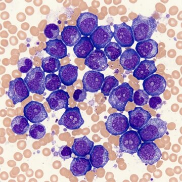 Leukemia Cells Abnormal White Blood Cells Under Microscope Hematology Medical Photography