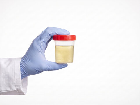 doctor holding a transparent urine sample container filled with cloudy pale yellow urine for laboratory testing and medical diagnosis