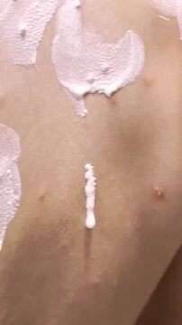 Applying soothing ointment to a 6-year-old boy with chickenpox
