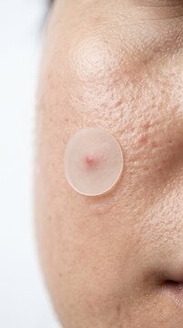 Translucent Hydrocolloid Micro Dart Skin Patch on Cheek