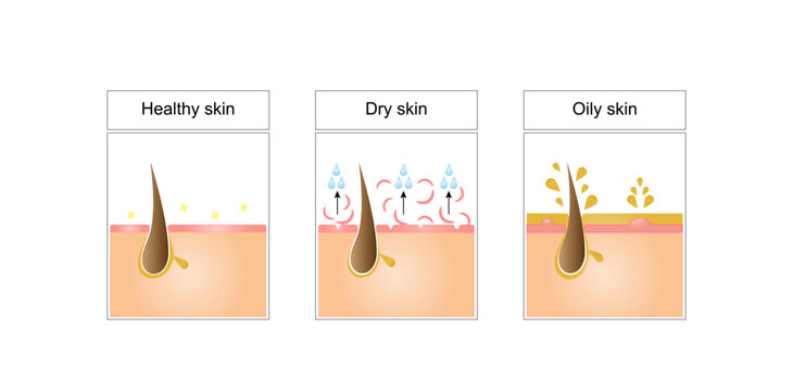 Healthy, Oily and dry skin. Human Skin types and conditions on white background. Skin care products, azelaic Acid, hyaluronic acid, moisturizer. Vector illustration.