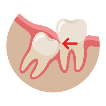 Impacted wisdom tooth pushing molar showing dental pain and gum impaction