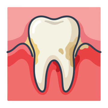 Tooth with plaque tartar gingivitis and bleeding gums dental oral inflammation care
