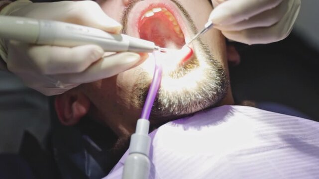 An unrecognizable dentist performs a professional cleaning of the lower jaw using a probe, a mouth mirror, and a saliva ejector on a young Caucasian man. Close-up side view with slow motion. Concept: 
