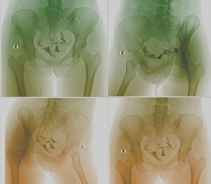 Normal hysterosalpingography (HSG) X-ray showing healthy uterus and fallopian tubes.
