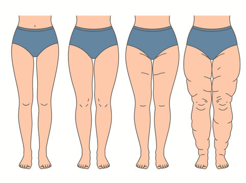 Stages of Lipedema and Lymphedema Progression in Female Legs Medical Illustration