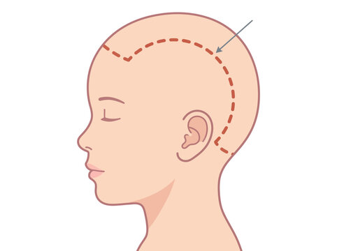 Medical Illustration of Surgical Incision Line on Child's Head for Craniosynostosis or Neurosurgery Procedure