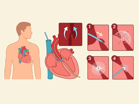 Medical Illustration of Atrial Septal Defect (ASD) Closure Procedure with Heart Occluder Device and Catheter
