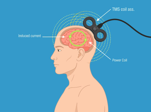 Medical Illustration of Transcranial Magnetic Stimulation (TMS) showing Magnetic Field and Induced Electric Current in the Human Brain