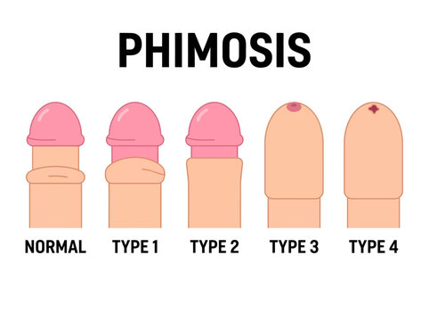 Medical Diagram Illustrating Phimosis Types and Severity Levels from Normal to Grade 4
