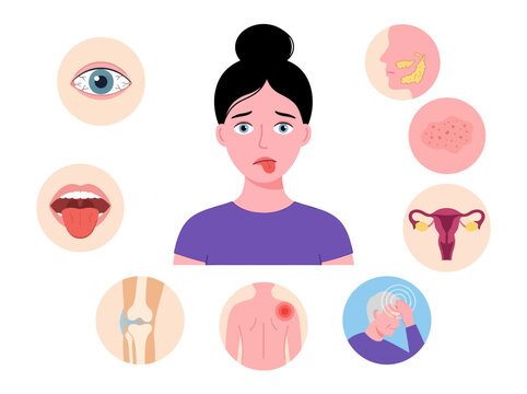 Sjogren's Syndrome Symptoms Infographic - Woman with Dry Eyes, Dry Mouth, Joint Pain, and Chronic Fatigue