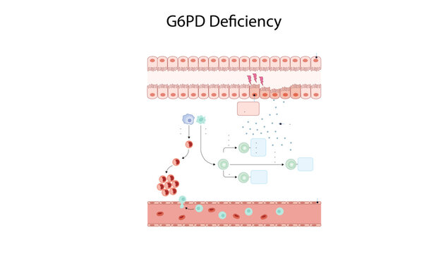  G6PD Deficiency, Medical illustration depicting the pathophysiology of Glucose-6-Phosphate Dehydrogenase (G6PD) deficiency, highlighting oxidative stress, red blood cell damage, and the mechanism 