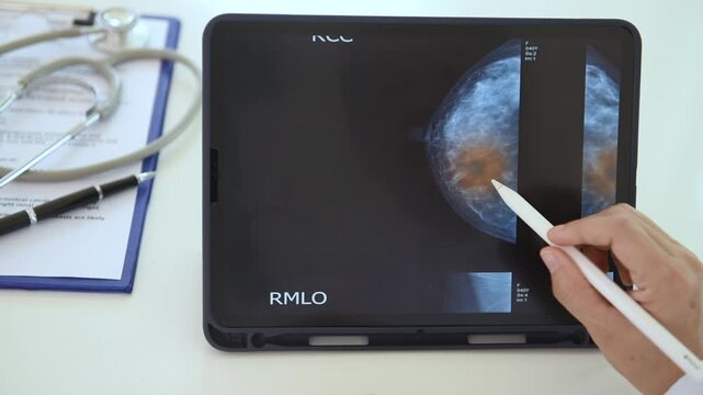 Radiologist or Surgeon doctor looks result of mammography on digital tablet to diagnose breast  cancer from mammogram at medical center.