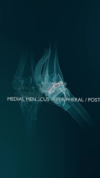Vertical video: Opening clip showing knee rotating in teal, marking medial meniscus with markers