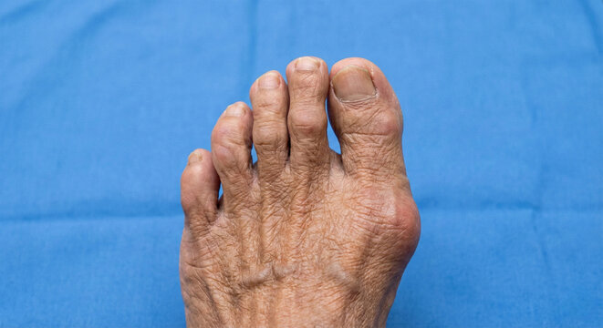 Side view of human foot with hallux valgus and bunion deformity on wooden floor, concept of orthopedic problems and foot health