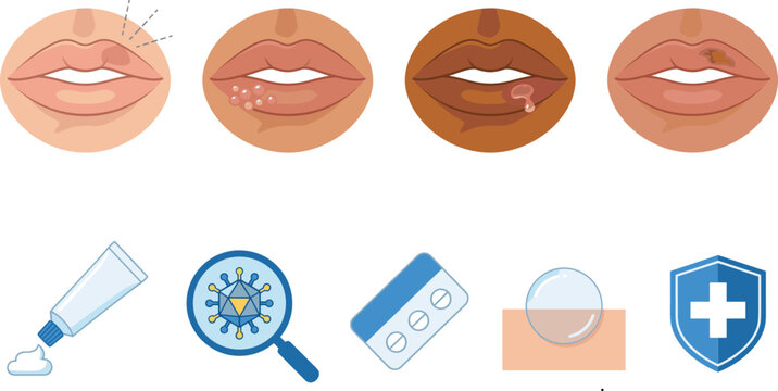 Herpes Labialis Cold Sore Lip Infection Vector Icon Set with Blister Symptoms Ointment Cream Pills and Virus for Medical Infographics