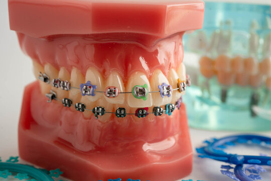 Orthodontic ligatures rings and ties, elastic rubber bands on orthodontic braces, model for dentist studying about dentistry.