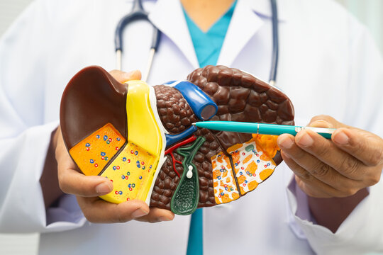 Cirrhosis, Liver cancer, fatty liver, Asian doctor with liver human anatomy model in World Hepatitis Day at hospital.