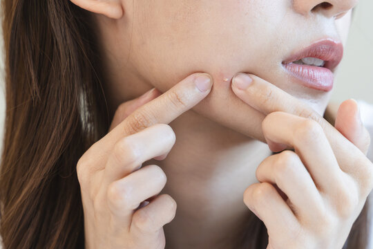 skin problem treatment. Women looking acne on her face in the mirror.